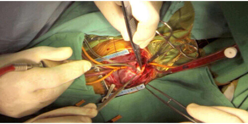 Pediatric Cardiothoracic Surgery