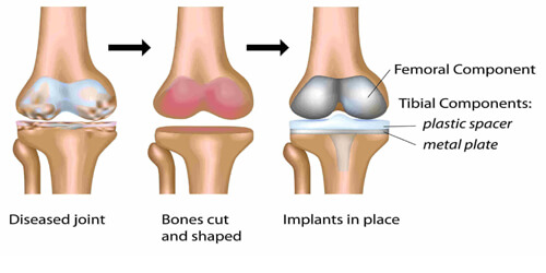 Joint Replacement 