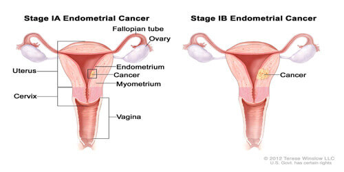 Endometrial 