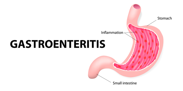 GASTROENTERITIS