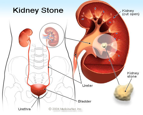 GALLSTONES